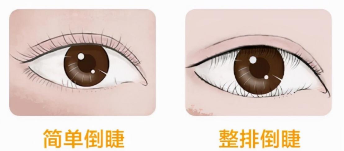 小孩睫毛倒长手术影响外观吗,婴儿睫毛倒睫拔除