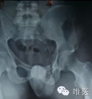 尾骶骨骨折错位突出怎么办,骶骨骨折能手法复位吗