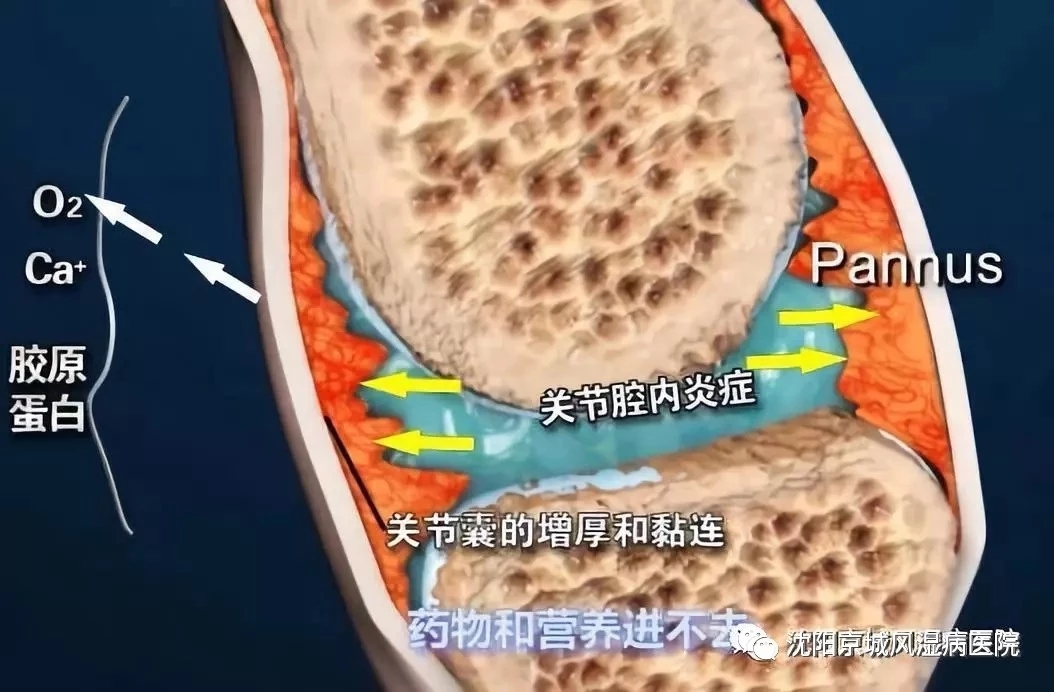 沈阳京城类风湿医院,沈阳京城医院治疗类风湿靠谱吗