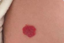 宝宝身上有不光滑胎记,宝宝身上胎记不哭就没有