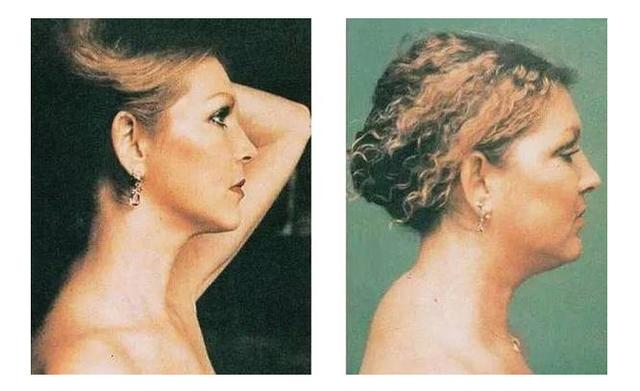 富贵包肩膀脂肪厚怎么消除,富贵包脖子前倾背厚快速消除方法