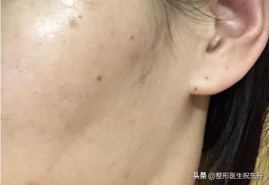 埋线可以提升吗,埋线提升一个月有什么坏处