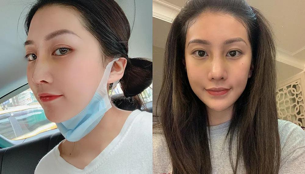 脸部微整形风险,脸部微整形图片大全