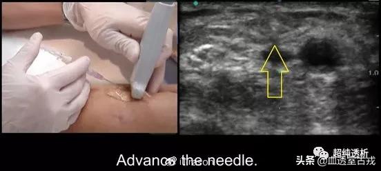 超声引导下血管穿刺效果评价,超声引导下血管穿刺置管流程