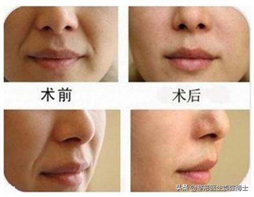 25岁有法令纹怎么改善,每天三分钟去掉法令纹的小技巧