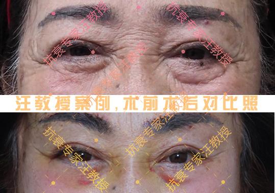 中医治眼袋大泪沟深自己怎么调理,二个方法解决眼袋泪沟七天有效