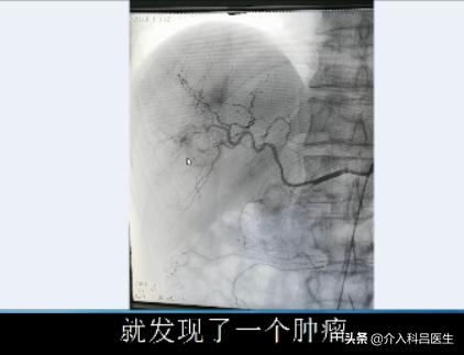 肝上长肿瘤做手术从背后做吗,肝癌介入杀死肿瘤的案例