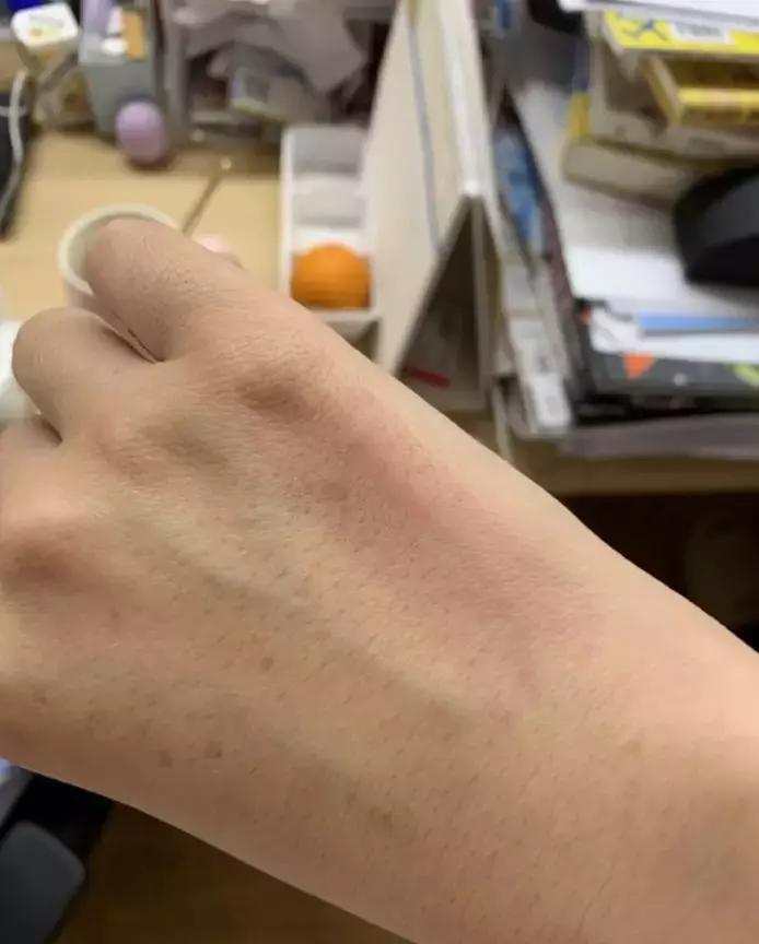 孕妇被蚊子咬了怎么止痒消肿,蚊子咬了止痒消肿最快的办法