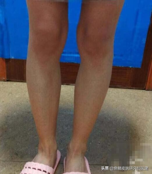 鱼鳞病病自愈的真实例子,鱼鳞病的真实治疗方法