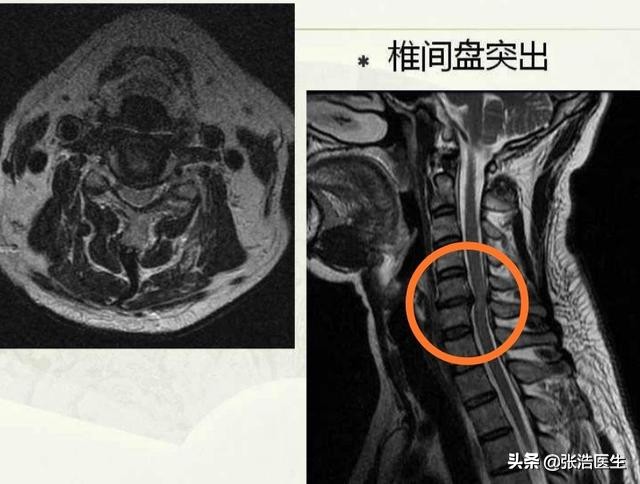 颈椎病不治疗可以缓解吗?什么情况下需要手术?