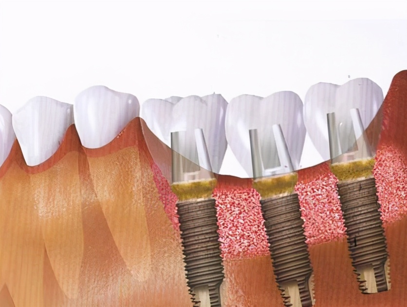 种植牙后果怎样,种植牙的风险和注意事项