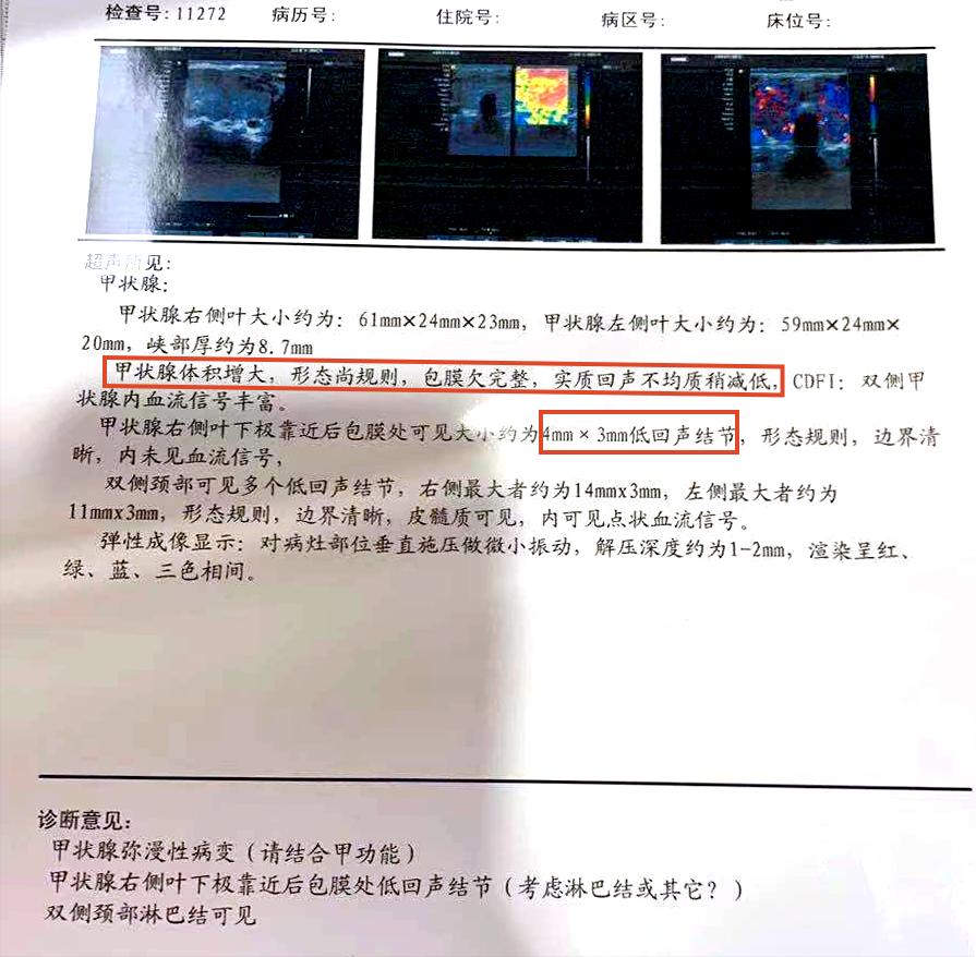 桥本轻微甲亢,桥本甲亢5年还没好