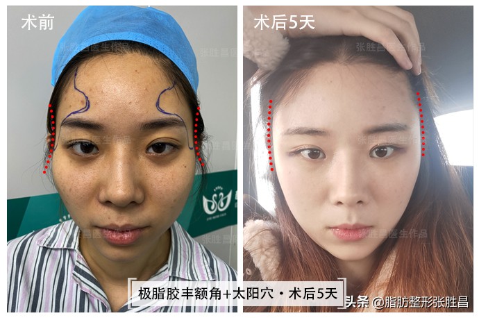 颧骨高只能颧骨内推？她怕开刀磨骨创伤大，仅做脂肪填充就改善了