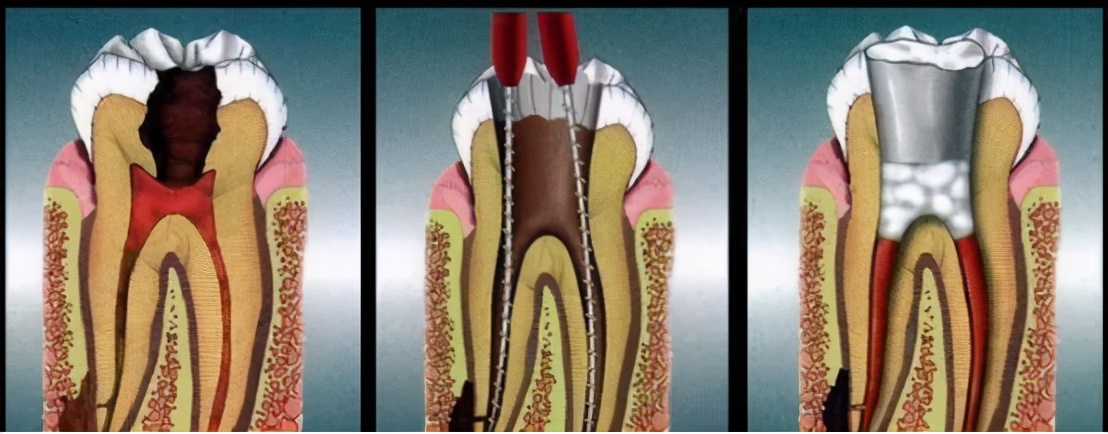牙齿残根不疼不拔好吗,牙齿残根不疼