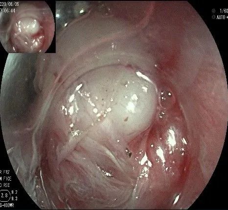 贲门隆起性病变影像,贲门溃疡隆起性病变