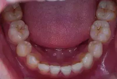 当牙齿出现小白点应该怎么办,当牙齿有黑线条