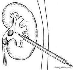 如果得了肾结石是不是必须碎石,如果得了肾结石如何治疗好