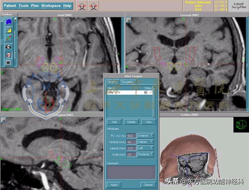 精神病微创手术后遗症,微创手术后瘀血尽快消除