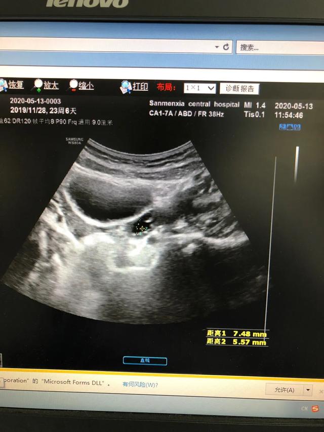 儿童性早熟要做哪些检查？怎么根据这些指标判断真性还是假性？