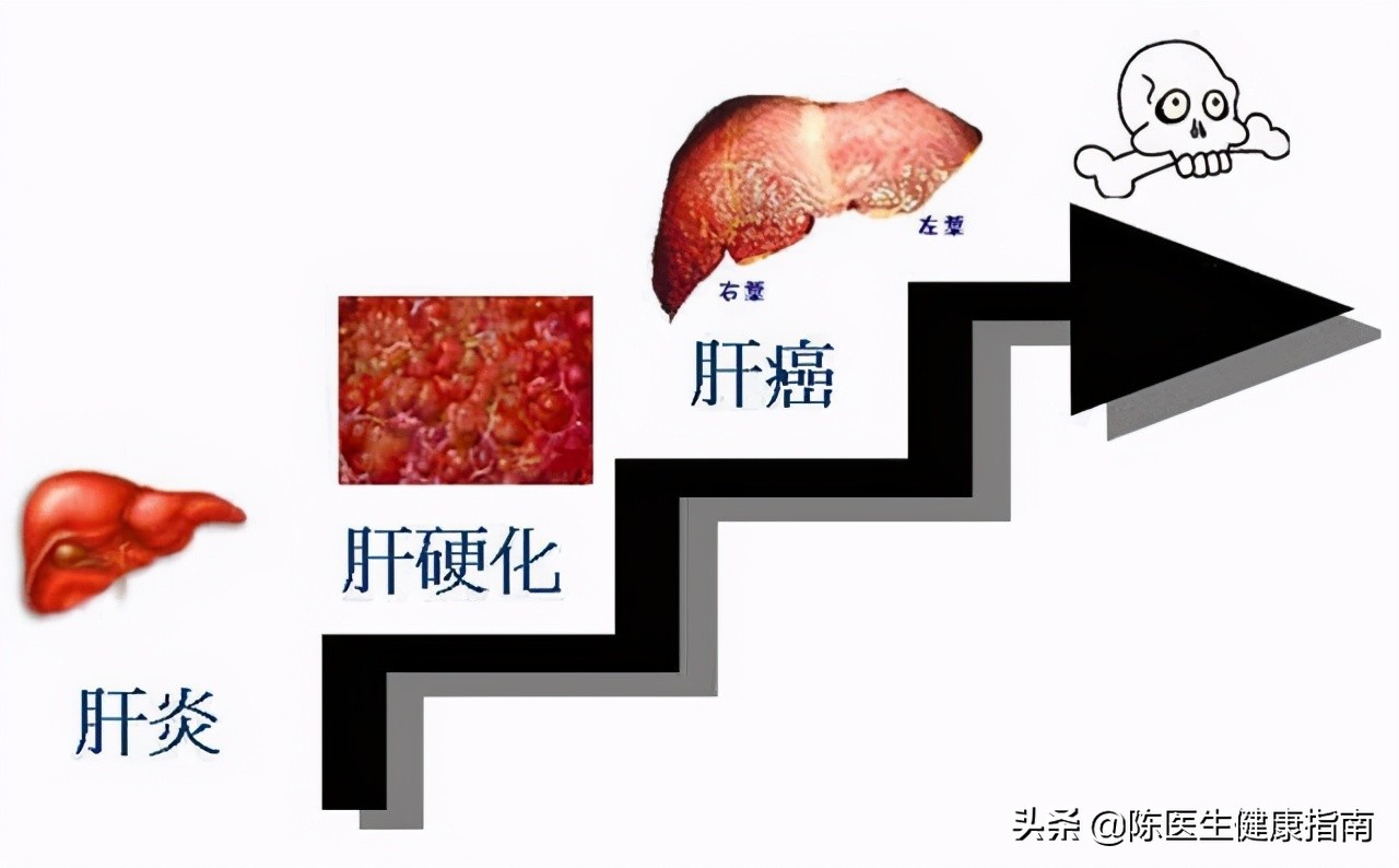 李兰娟院士：不要小看乙肝表面抗原的数值，它或可预测乙肝治愈率