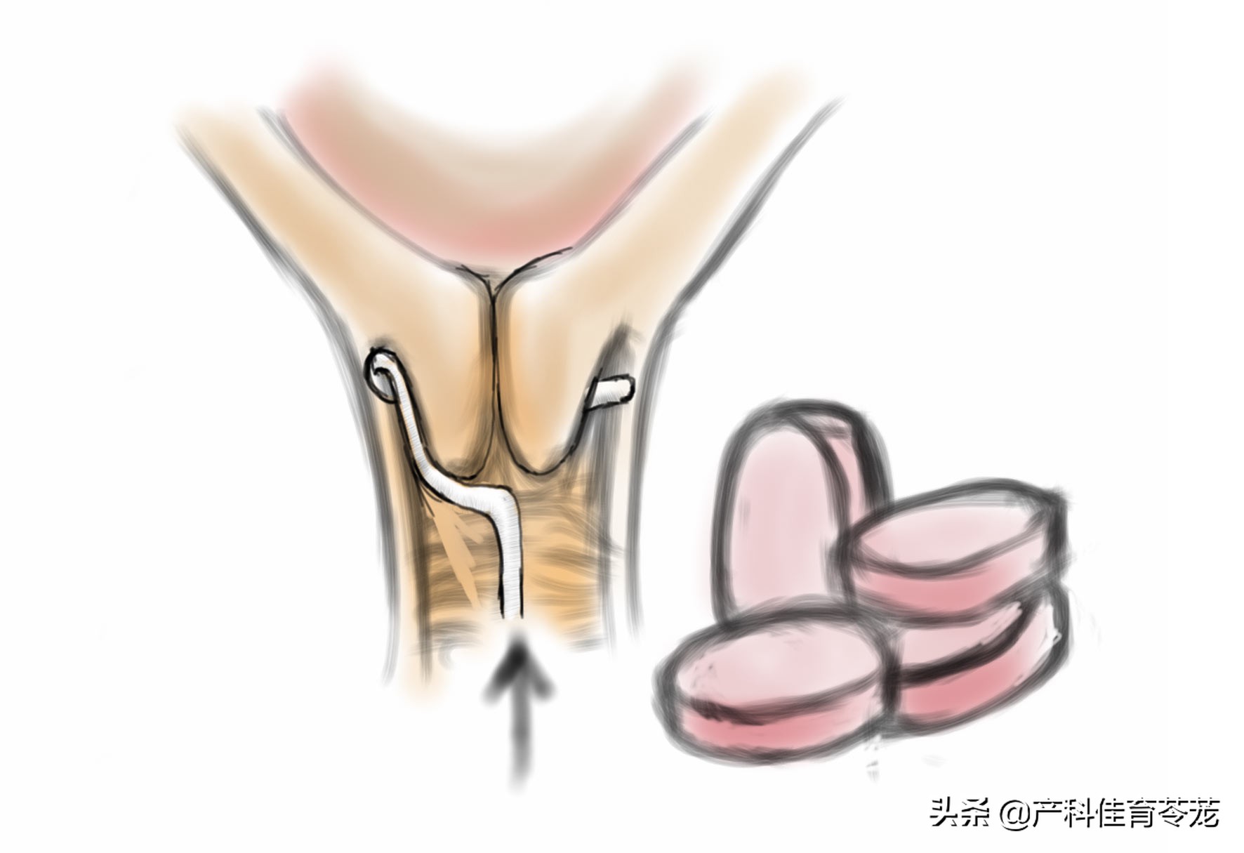 都是生孩子,为啥她点催产素,我要放药?