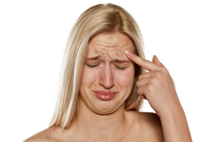 祛除痘坑痘印药膏,男士痘印痘坑怎么去除