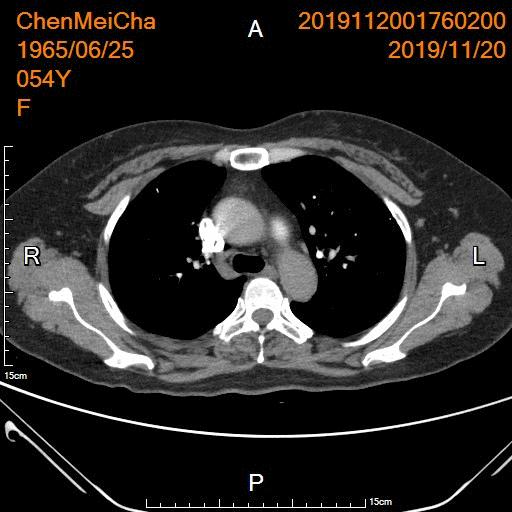急性肺栓塞的中医操作,肺栓塞微创介入取栓