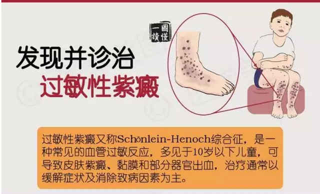 过敏性紫癜性肾炎,过敏性紫癜性肾炎的临床表现