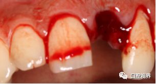 门牙折断牙根完好怎么办,门牙意外脱落怎么修复