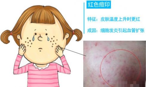 脸上的痘印有多少种,为什么你脸上的痘印反反复复