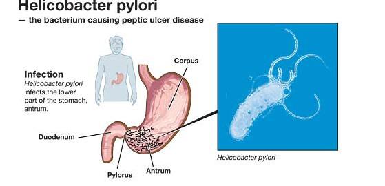 呼气试验结果越大，幽门螺旋杆菌感染就越重？在线医生请别乱说