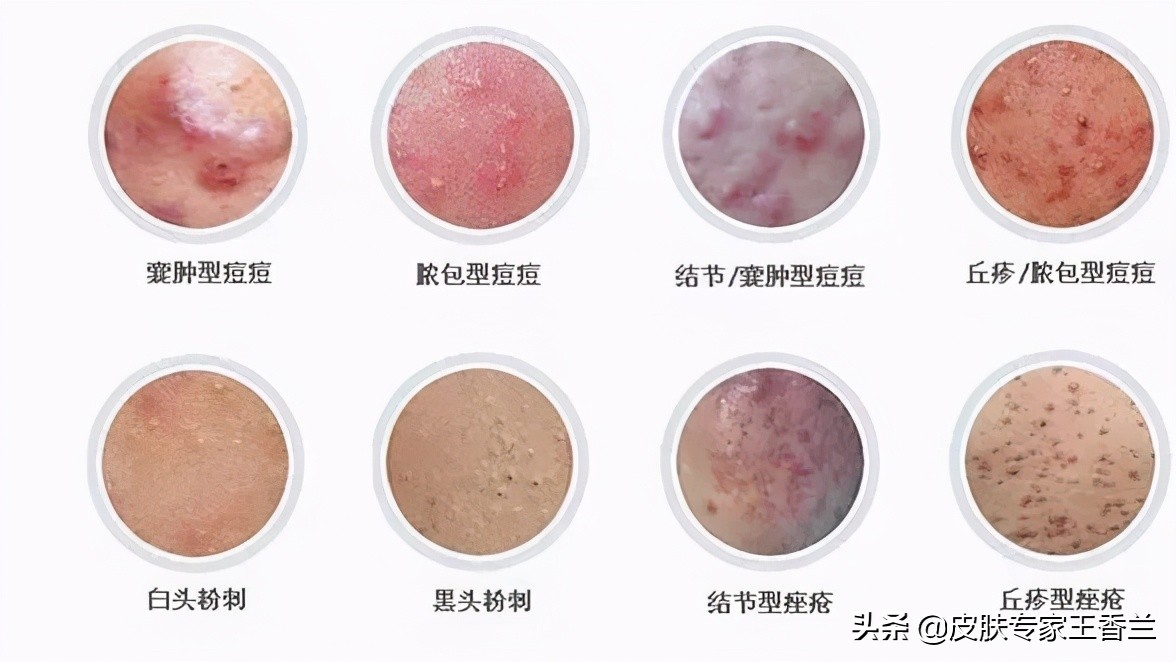 前胸后背长痘毛囊炎怎么办呢,怎样判断前胸后背长痘是毛囊炎