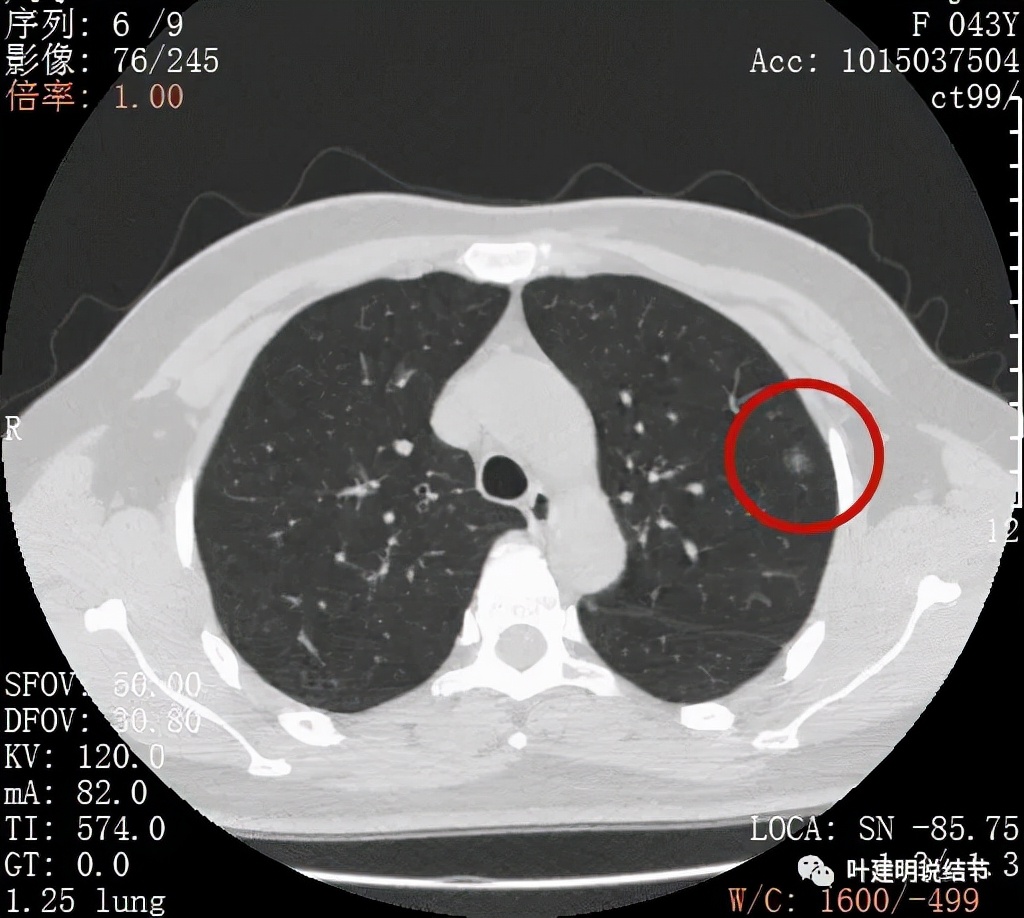 从活检怎么看是非小细胞癌,从病例谈辨证论治