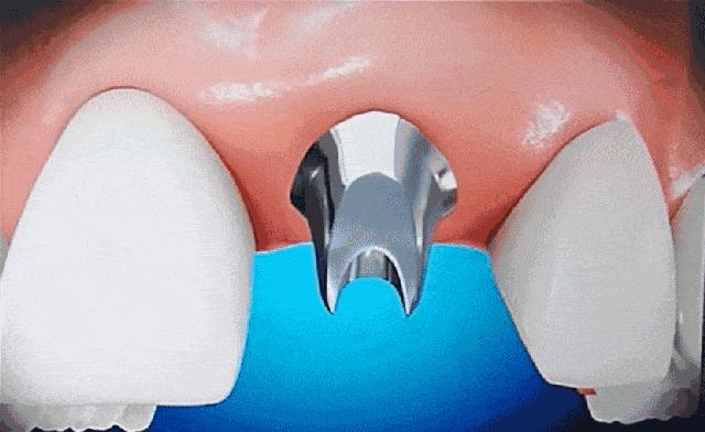 烤瓷牙和种植牙哪个副作用大,烤瓷牙和种植牙比较优缺点有哪些