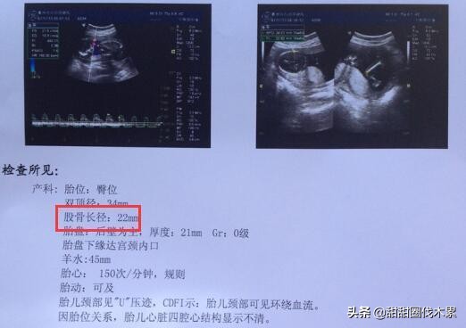 胎儿股骨过短会是短肢畸形吗,胎儿股骨不长会畸形吗