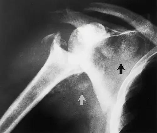 神经性骨关节病,神经性关节炎症状图片