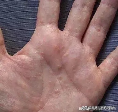 一到春天手痒起水泡怎么回事,一到春天手上密密麻麻起水泡疼