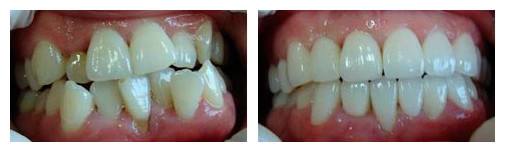正畸矫正知识,正畸知识科普视频