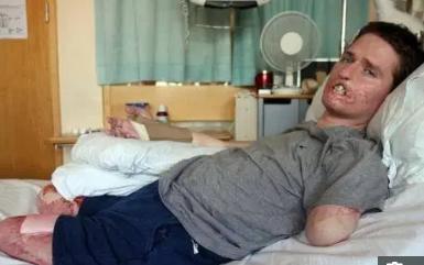 英国男子被狗咬了截肢,男子被动物咬脚趾截肢