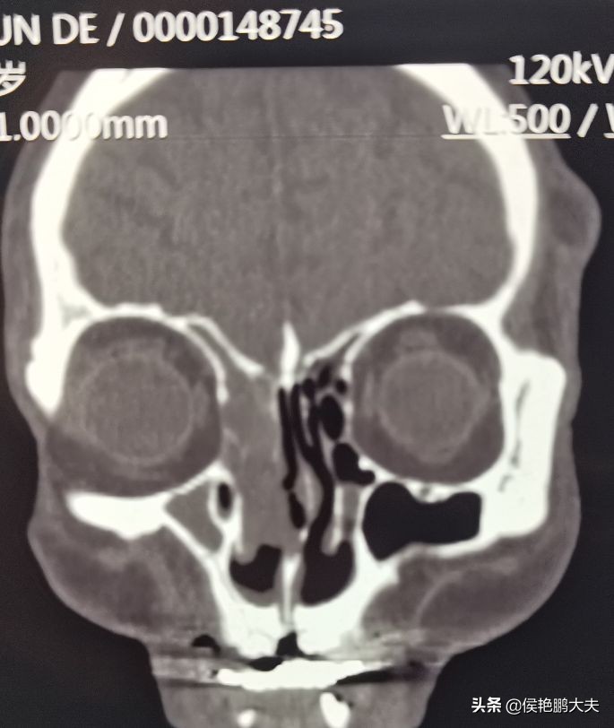 70岁老人鼻塞严重,老人鼻塞怎么治疗最快最有效