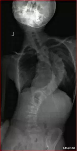 孩子脊柱侧弯真的是因为书包太沉,背书包会脊柱侧弯