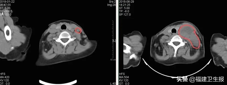 34岁女子宫颈癌自愈,女性患了宫颈癌能治愈吗