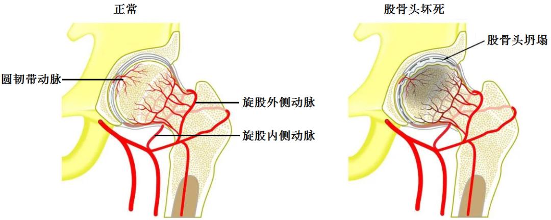 股骨头坏死微创置换术需多少钱,股骨头坏死初期保守治疗