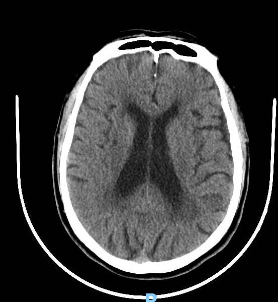 老年人基底动脉瘤几率,脑动脉瘤未破裂最佳治疗方法