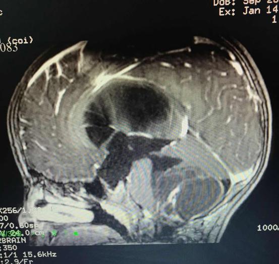 头痛头晕怀疑脑瘤,头痛发现脑癌