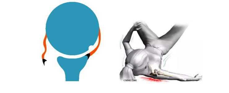 习惯性肩关节脱臼如何改善,肩关节脱位容易形成习惯性脱位吗