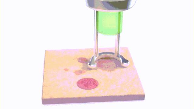 超皮秒避坑,超皮秒祛斑适合角质层薄的人