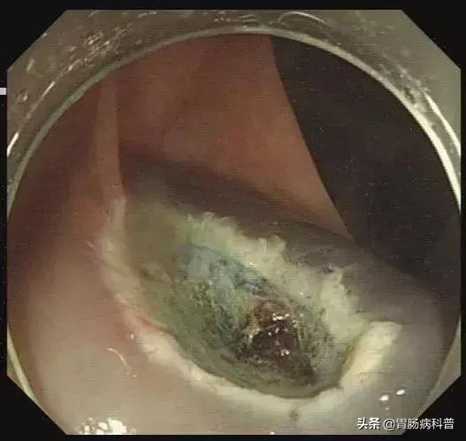 只要是肠息肉都要割掉吗,医生肠息肉切除后怎么处理伤口