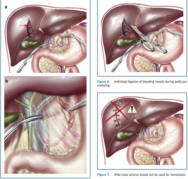 肝脏损伤的诊断和处理,肝脏损伤ii级