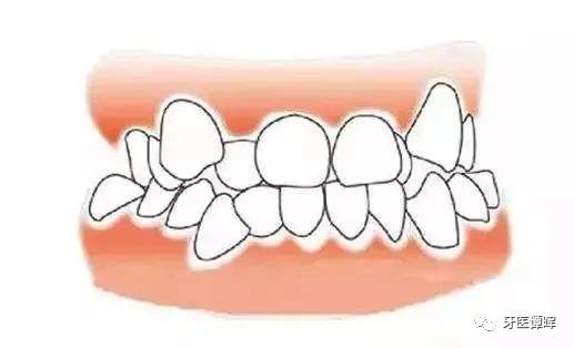 牙齿不齐牙列拥挤怎么矫正,牙列不齐拥挤矫正大约要多少钱